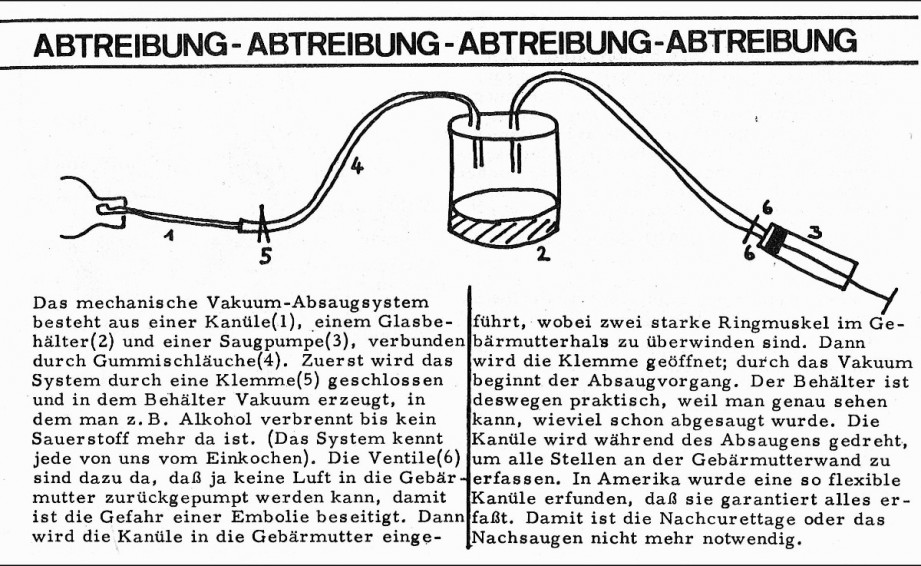 Absaugmethode, 1975